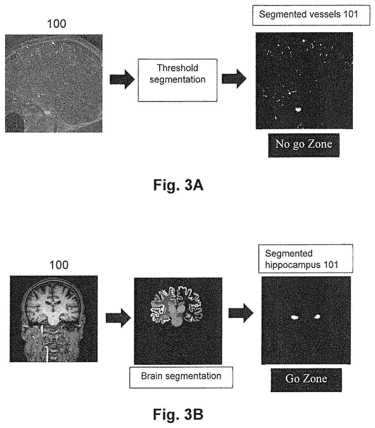 Computer implemented method, a system and computer programs for computing simultaneous rectilinear paths using medical images