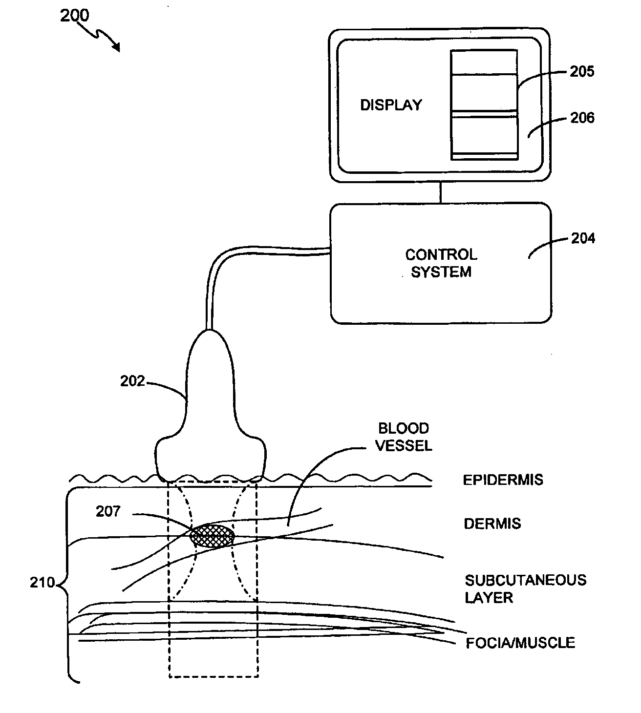 Method and system for treatment of blood vessel disorders