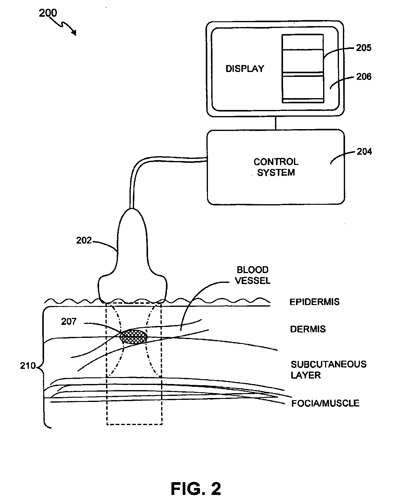 Method and system for treatment of blood vessel disorders