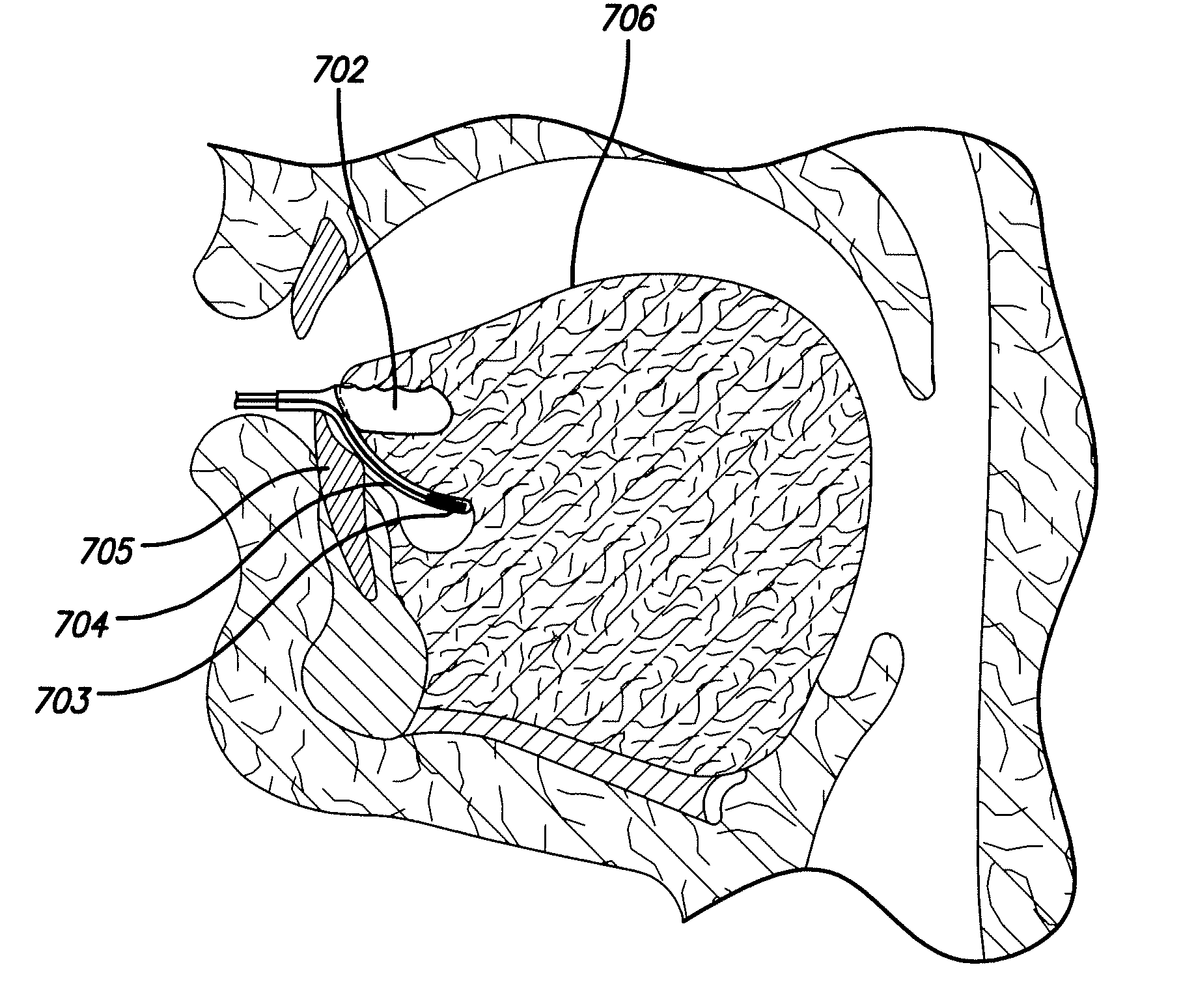 Apparatus and method for treating obstructive sleep apnea