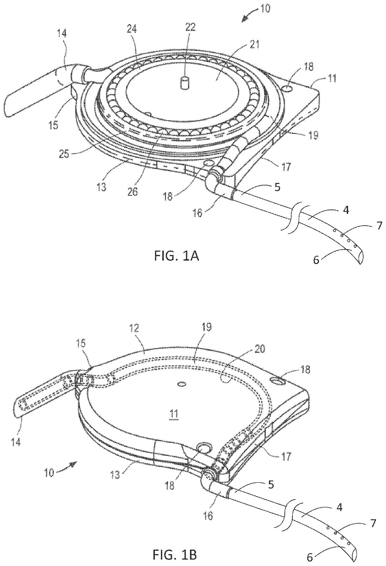 Apparatus and methods for treating excess intraocular fluid