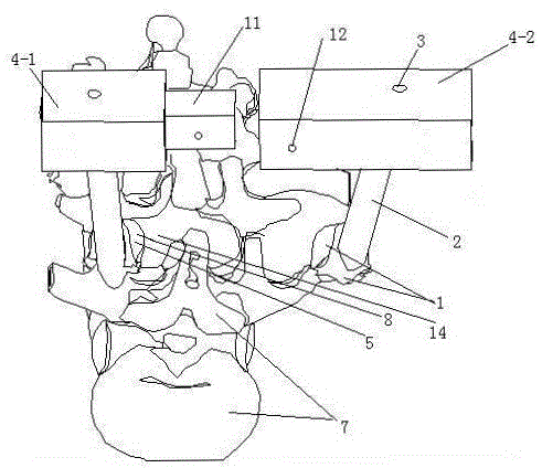 Disassembly type double-side type percutaneous individualized pedicle screw guiding template