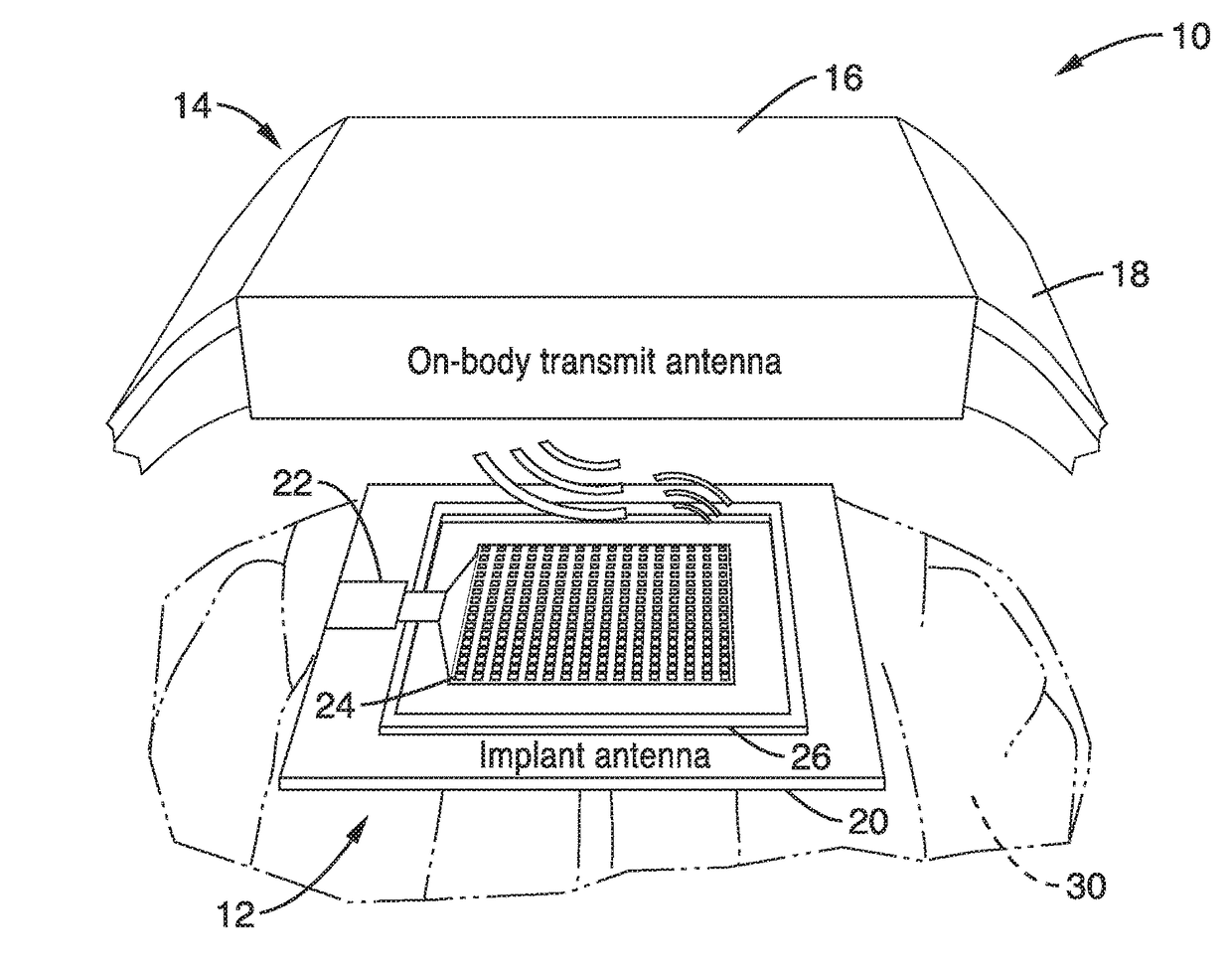 Monolithically integrated implantable flexible antenna for electrocorticography and related biotelemetry devices