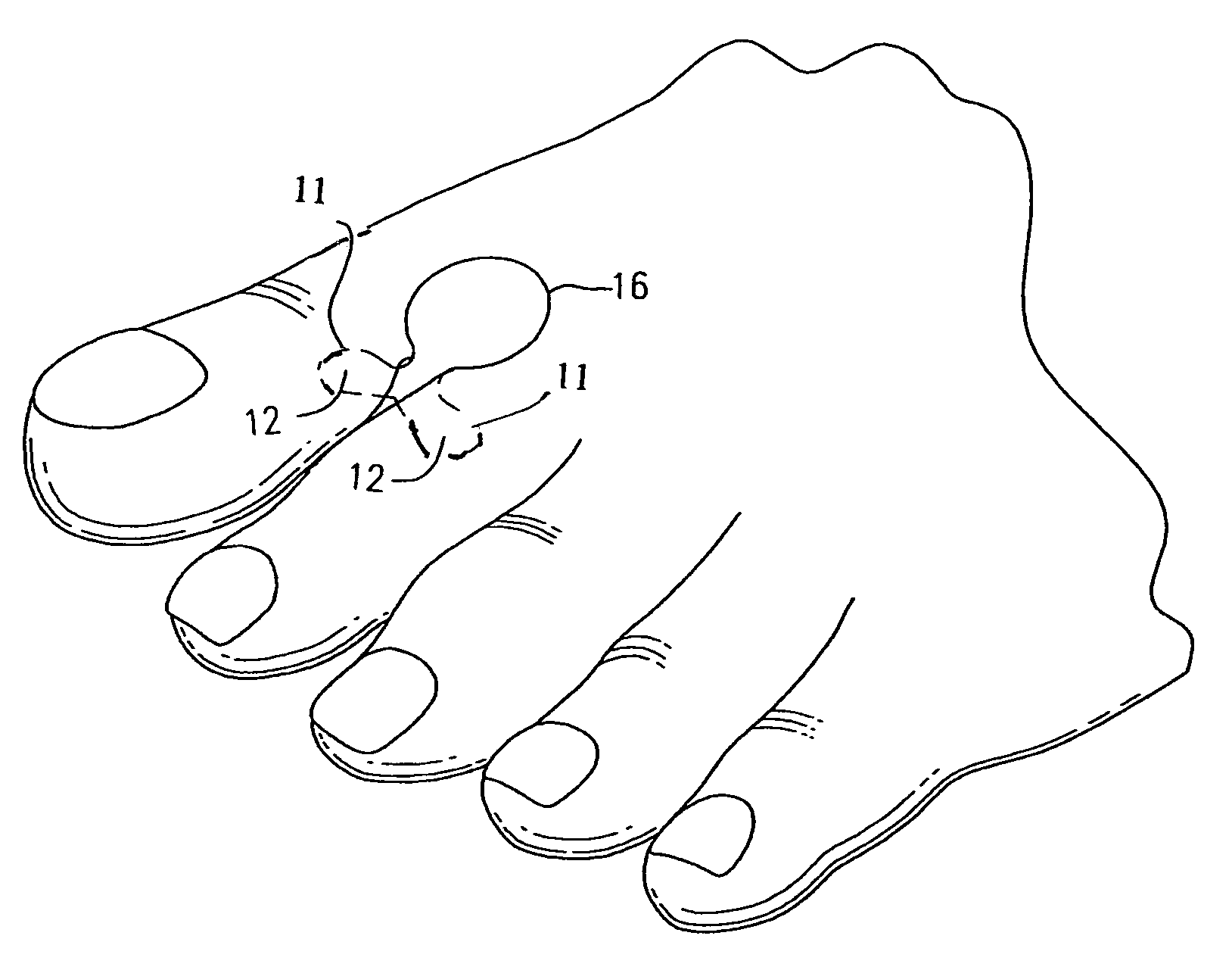 Protective device against frictional irritation due to wearing thong-type sandals and other footwear