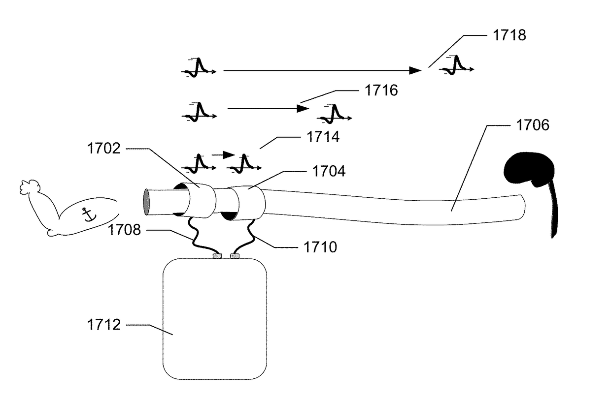 Neural monitoring methods and systems for treating upper airway disorders