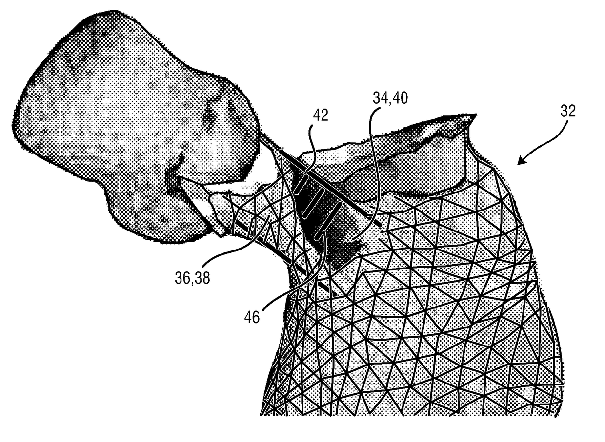 Planning an implantation of a cardiac implant