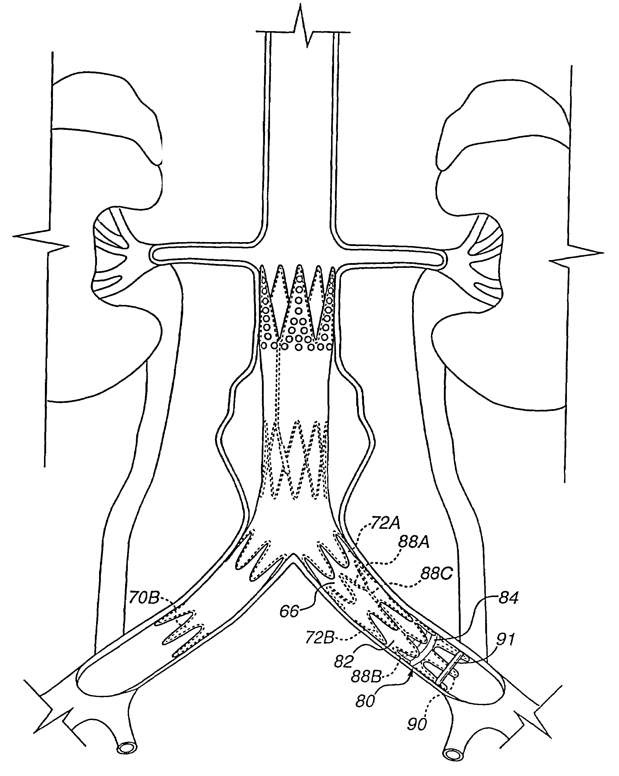 Apparatus for engrafting a blood vessel