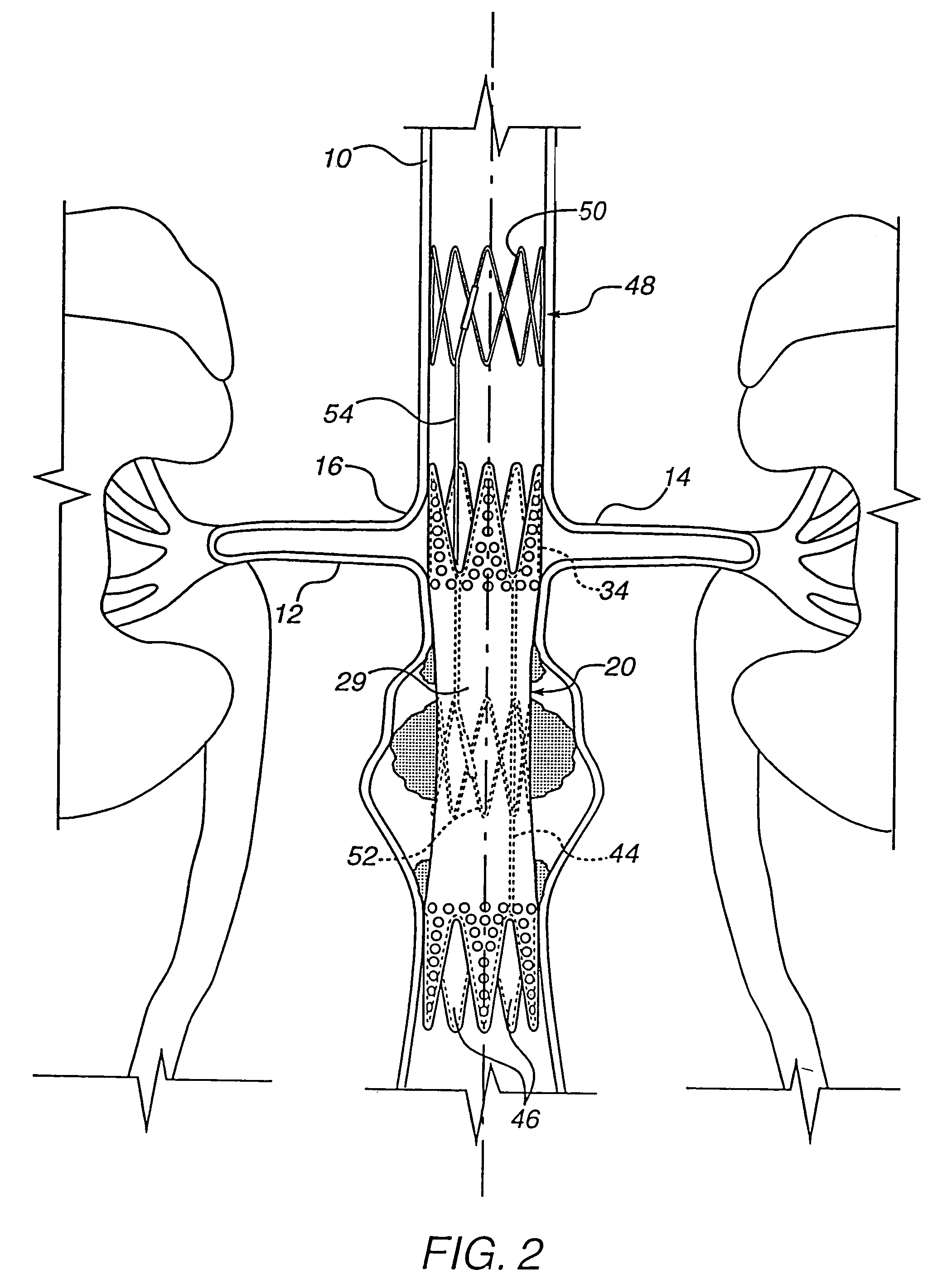 Apparatus for engrafting a blood vessel