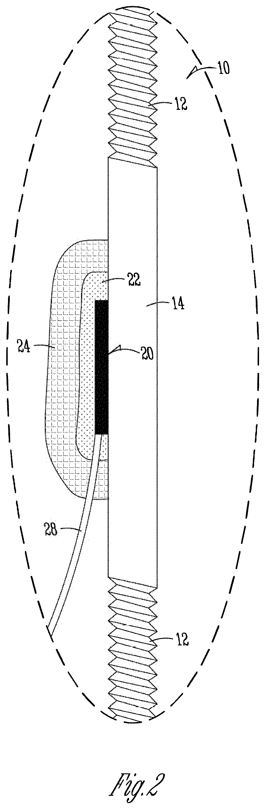 Mobile monitoring of fracture healing in external fixators