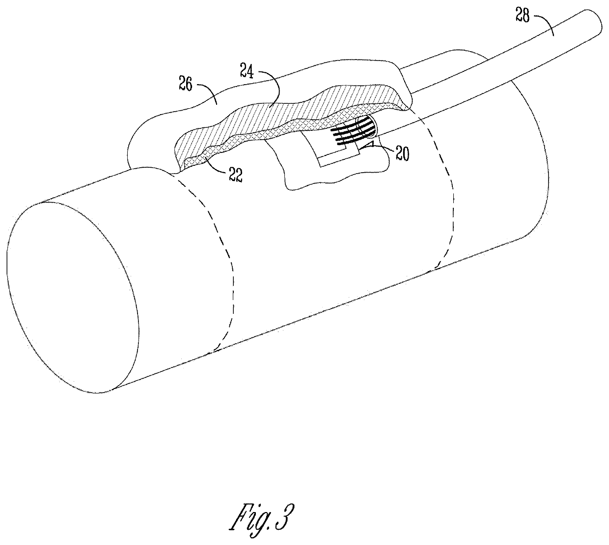 Mobile monitoring of fracture healing in external fixators