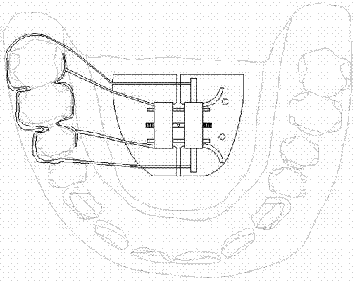 Implant anchorage combined single-side arch expansion device