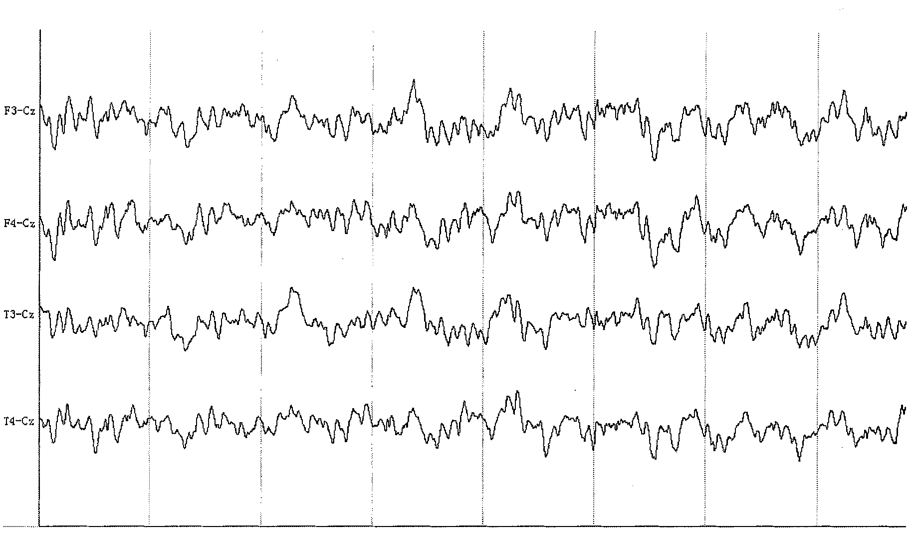 Rhesus monkey temporal lobe epilepsy kindling model and drug screening method thereof