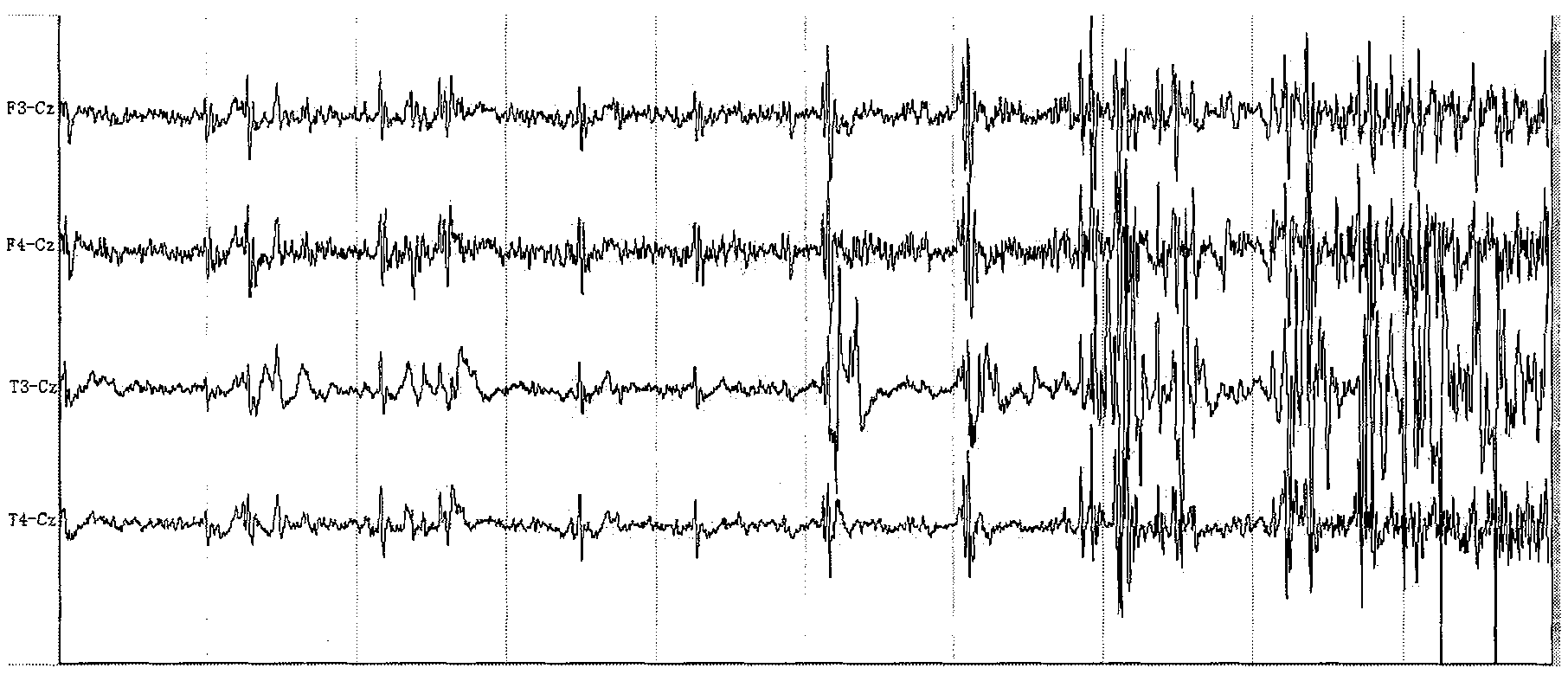 Rhesus monkey temporal lobe epilepsy kindling model and drug screening method thereof