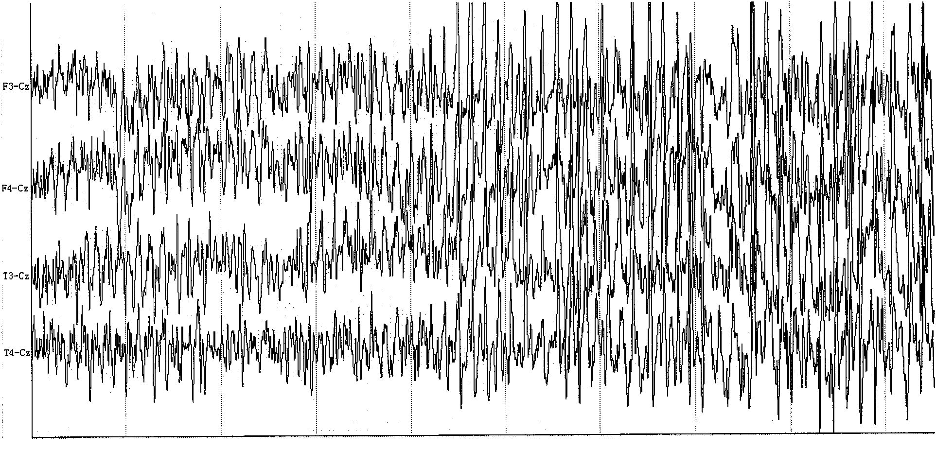 Rhesus monkey temporal lobe epilepsy kindling model and drug screening method thereof