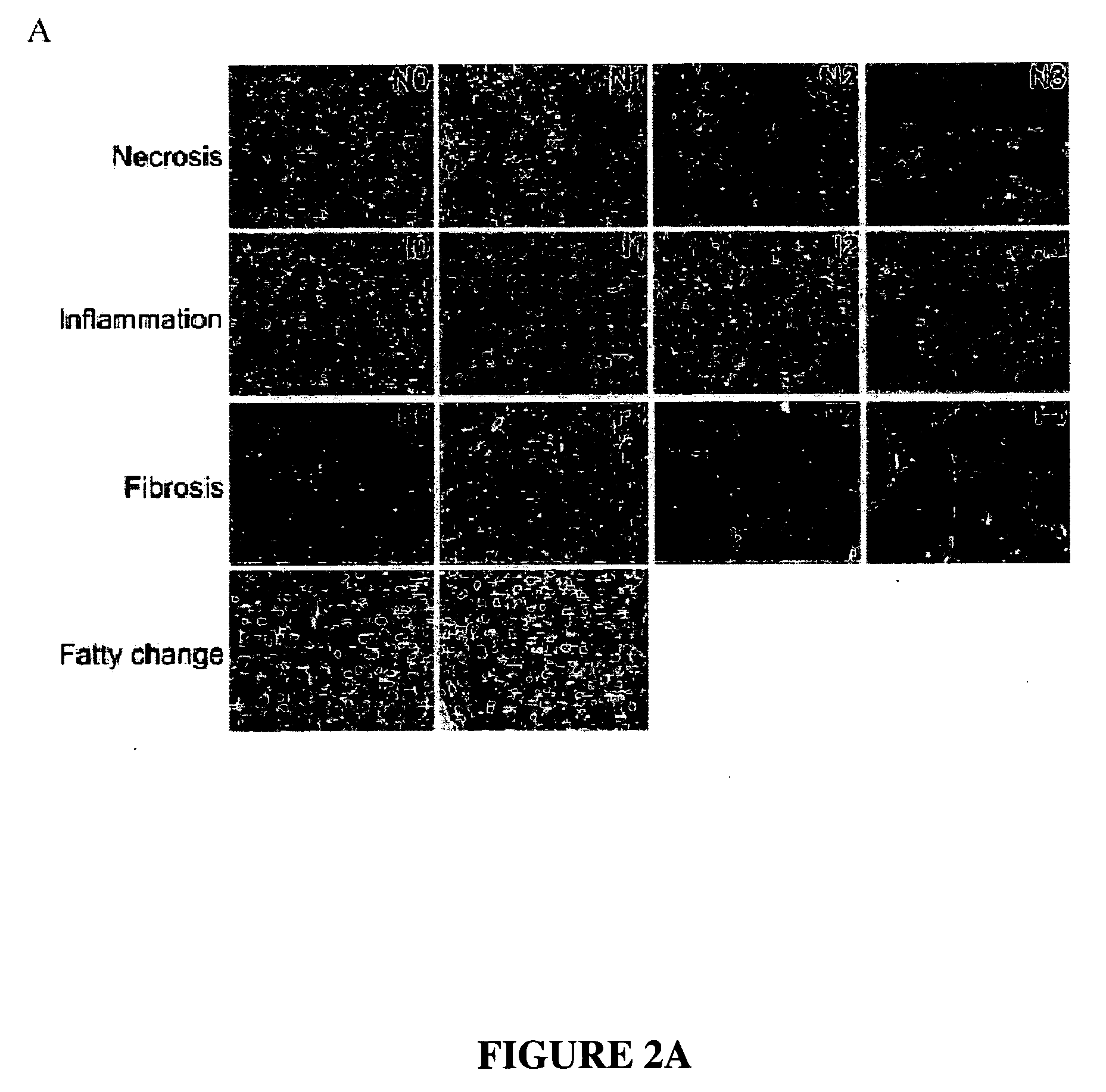 Biomarkers for liver fibrotic injury