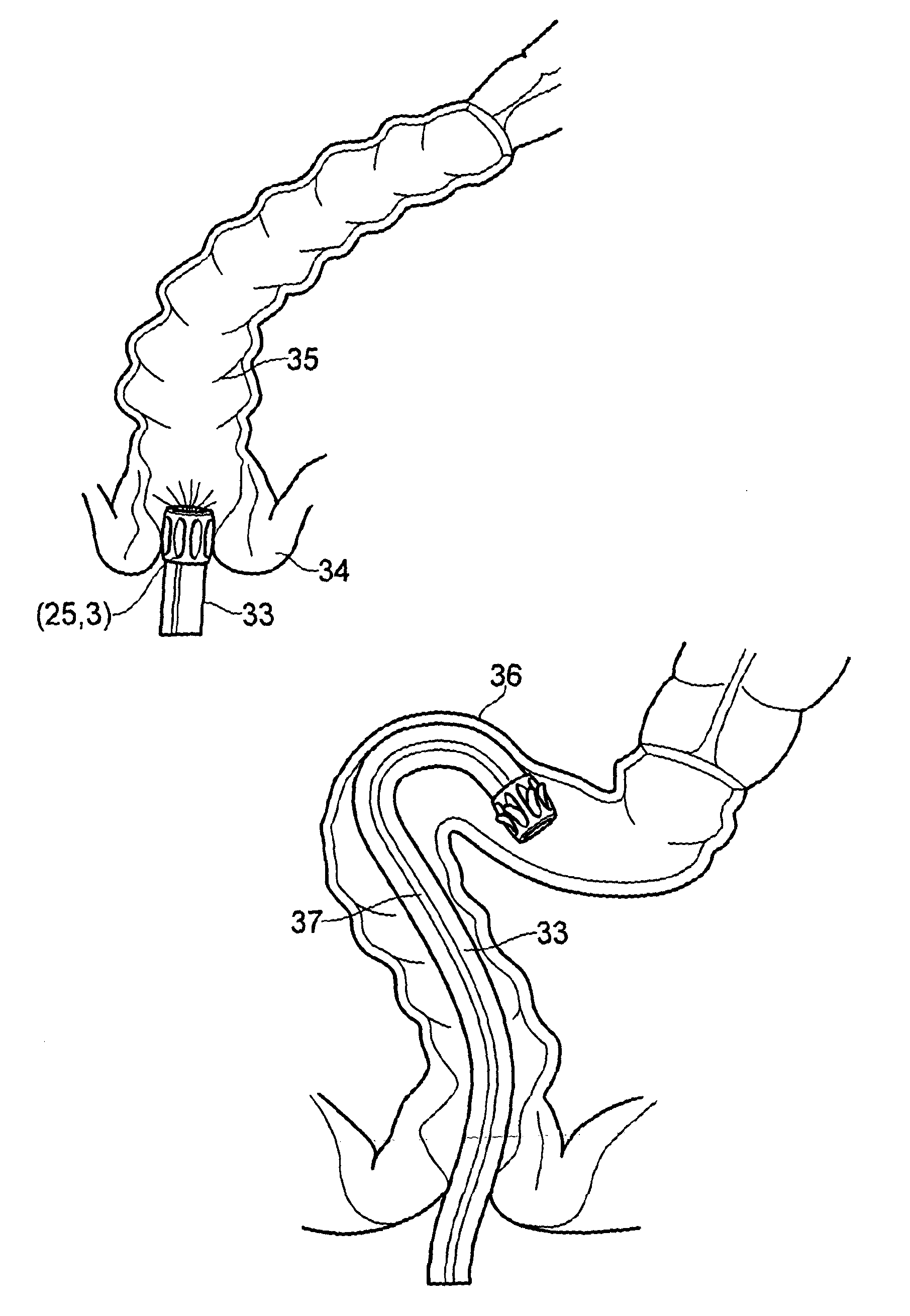 Covering for a medical scoping device