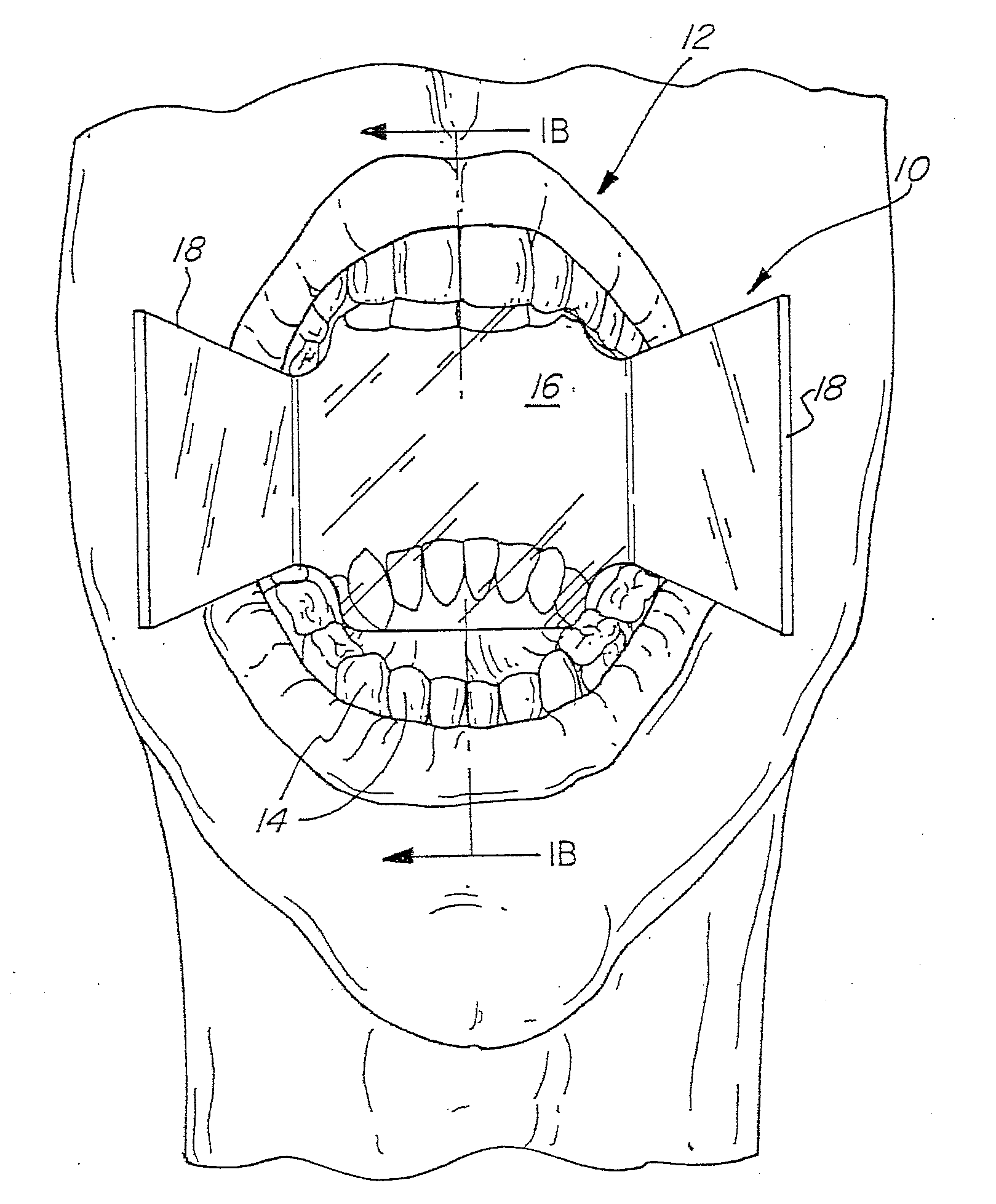 Dental bite block