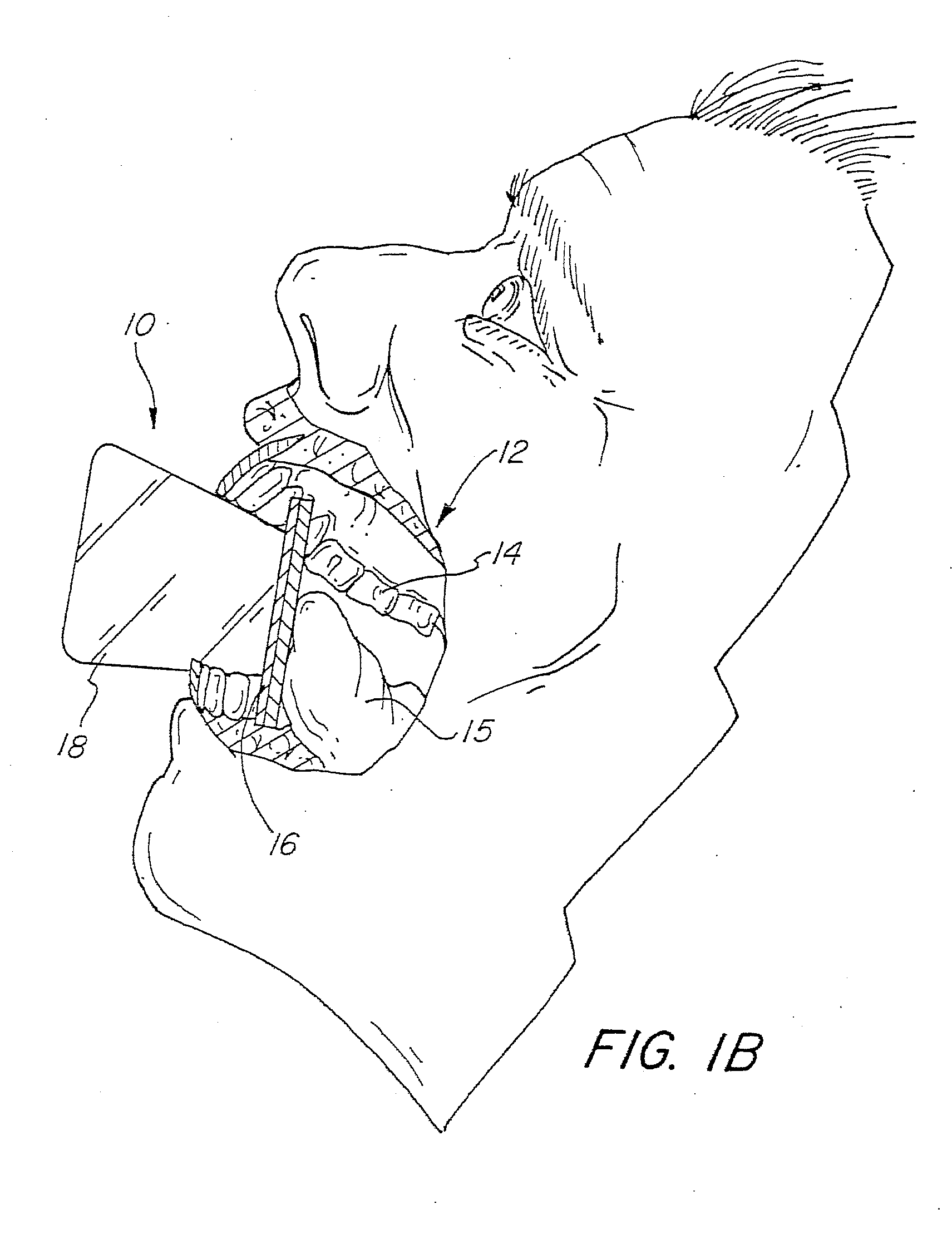 Dental bite block