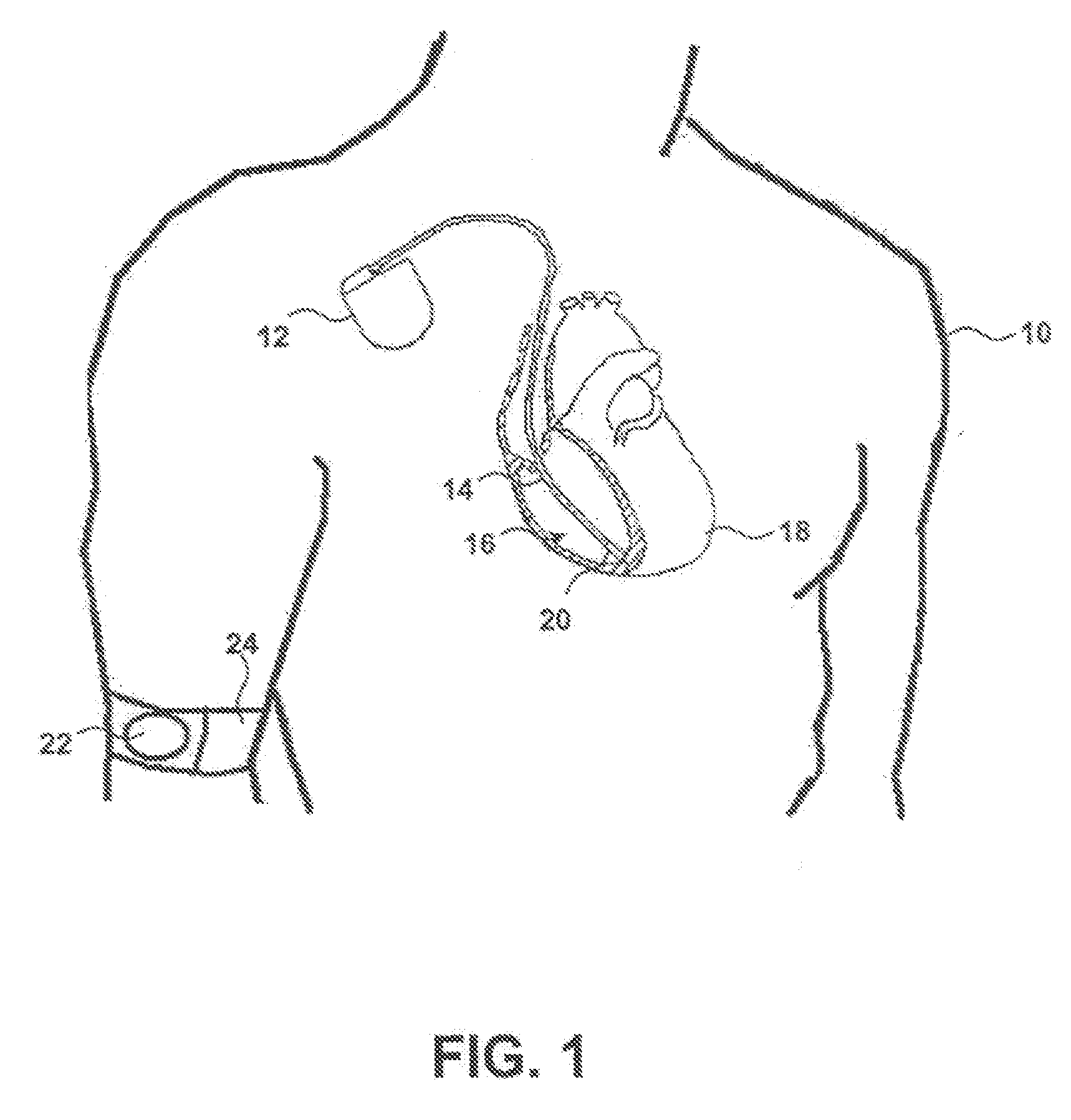 Implantable sensors having current-based switches for improved fault tolerance