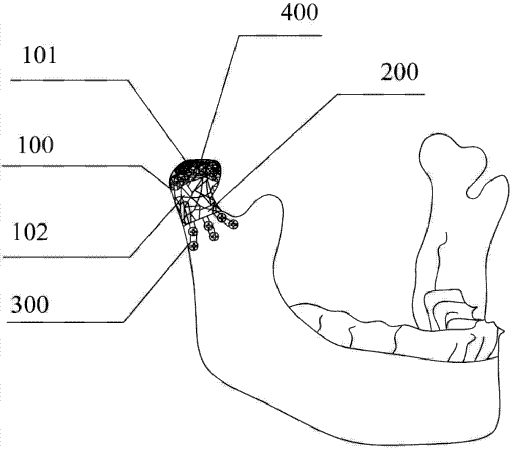 Condyle prosthesis and manufacturing method thereof