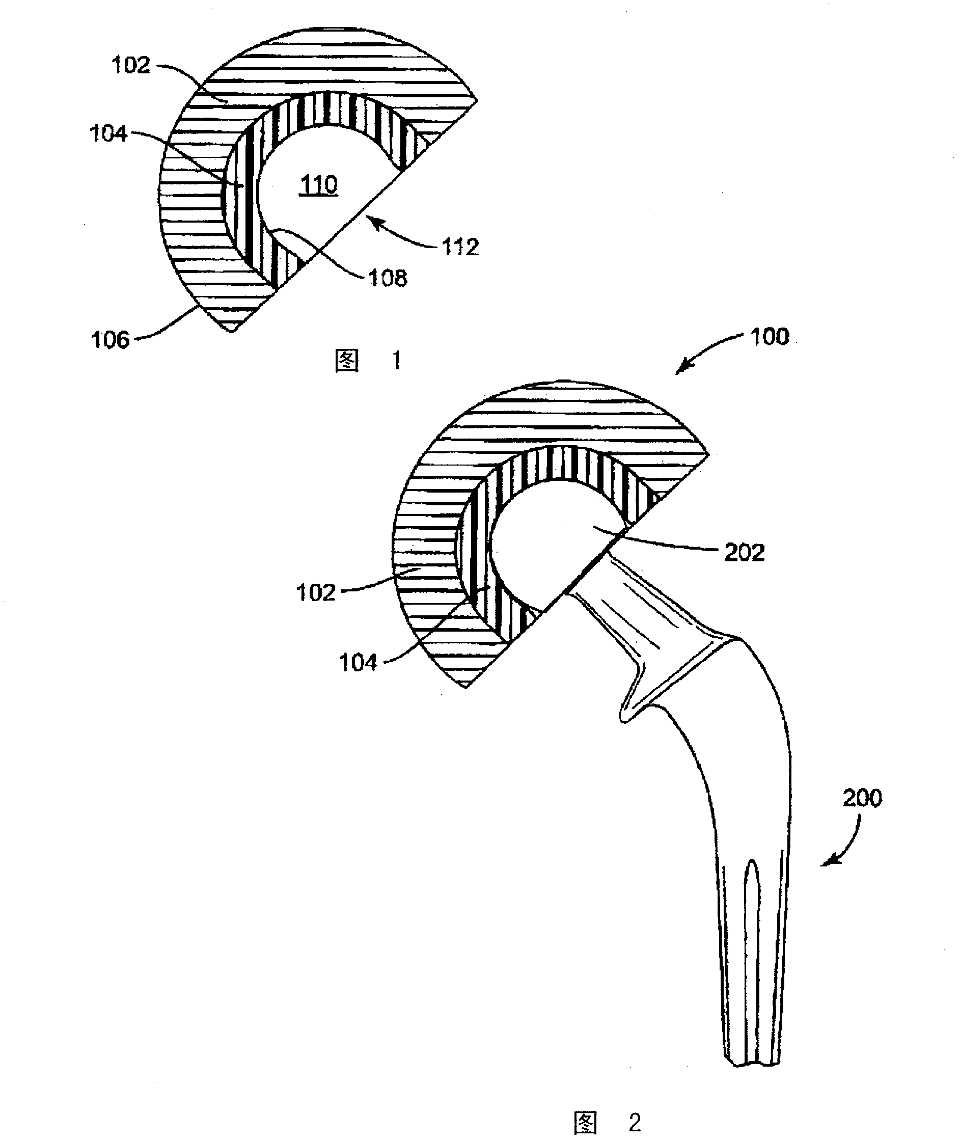 Revision hip implants and prosthesis systems