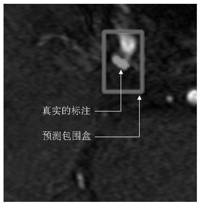 Aneurysm detection method and system based on MRA, terminal and medium