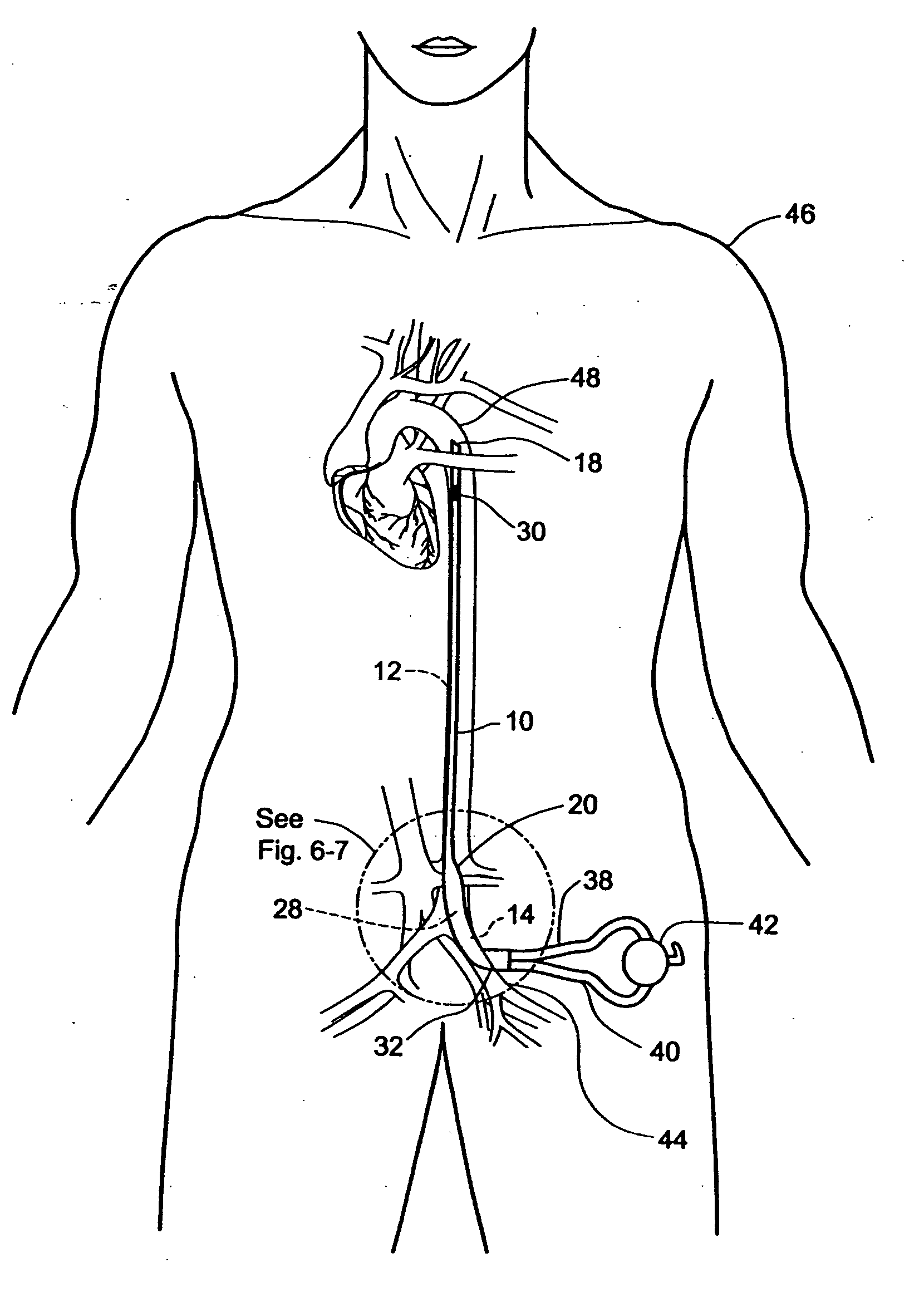 Multilumen catheter for minimizing limb ischemia