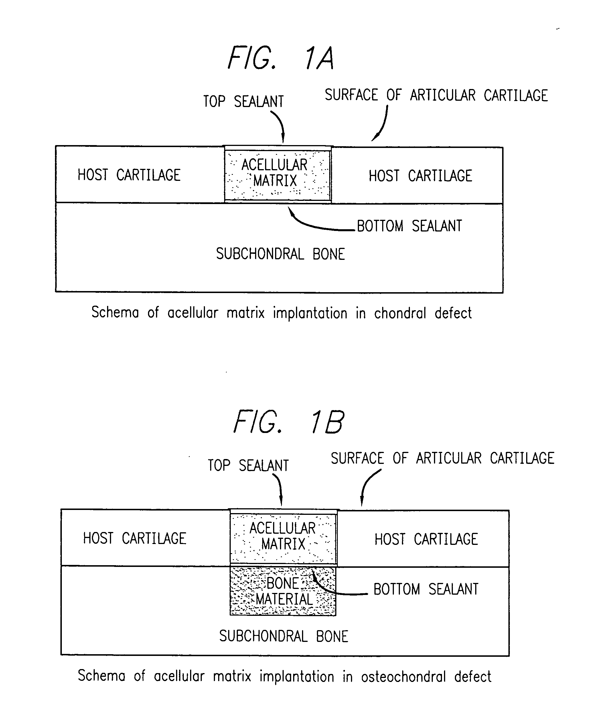 Biocompatible tissue sealant for treatment of osteochondral and bone defects using an acellular matrix implant