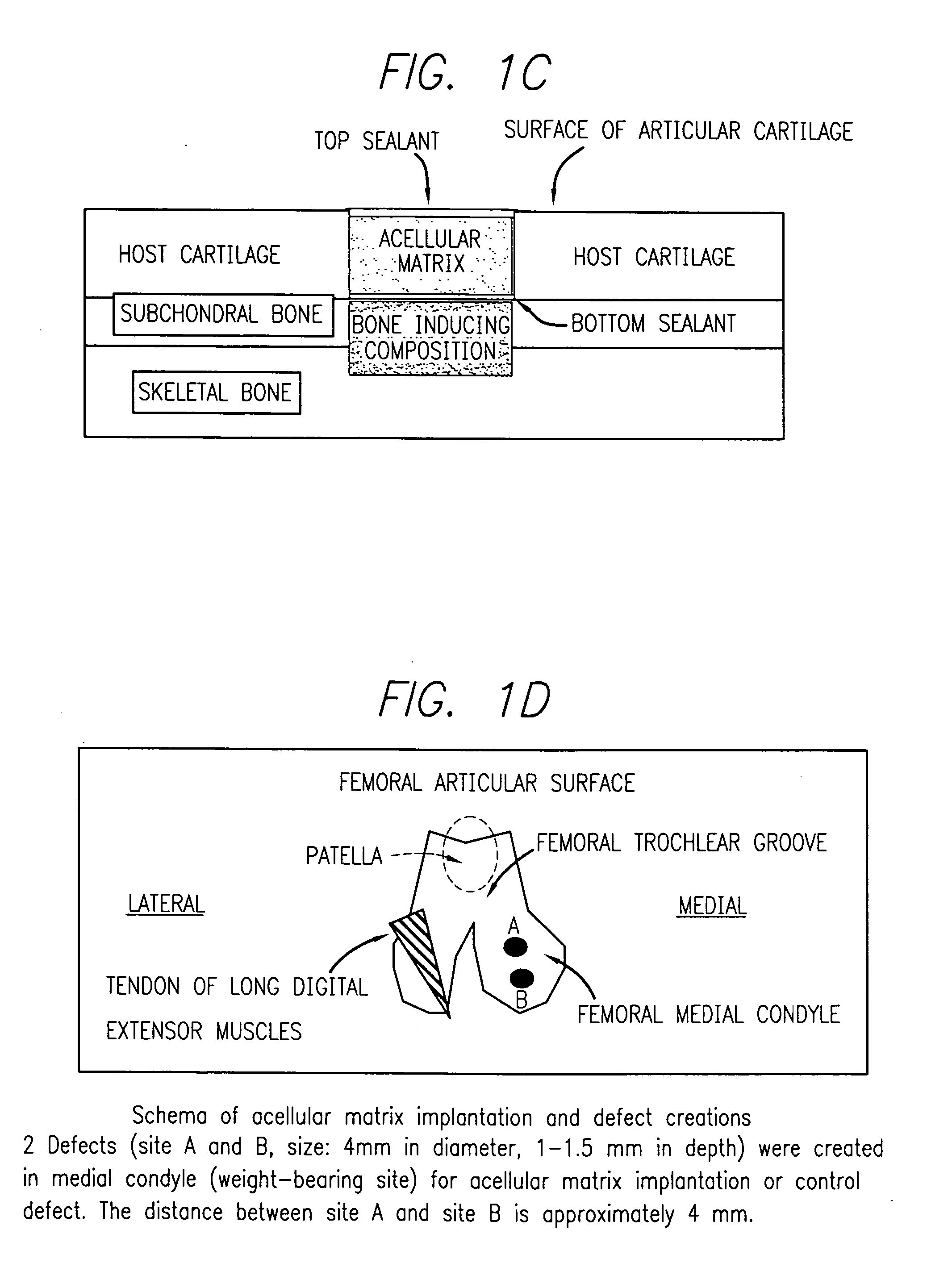 Biocompatible tissue sealant for treatment of osteochondral and bone defects using an acellular matrix implant