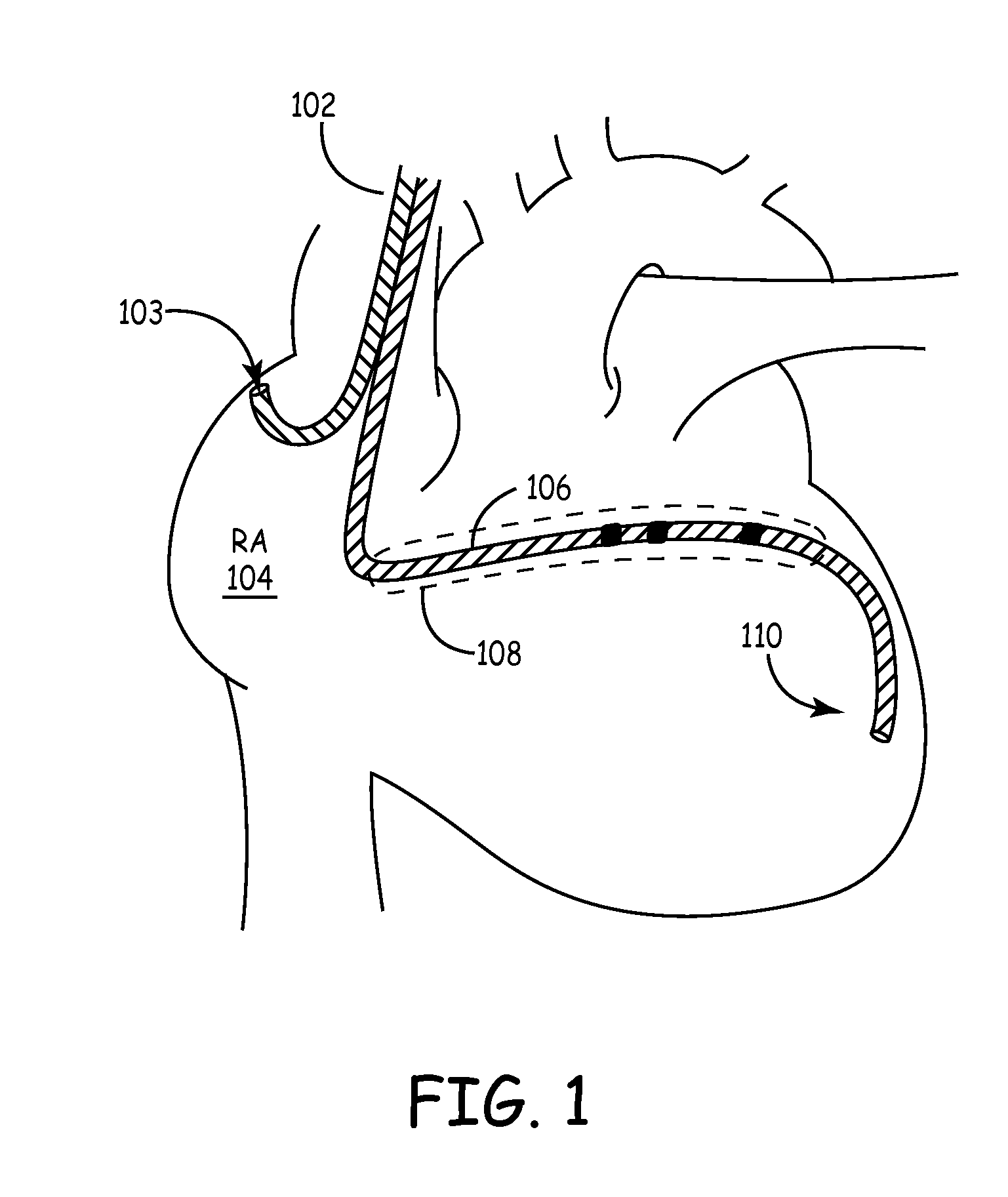 Predicting chronic optimal A-V intervals for biventricular pacing via observed inter-atrial delay