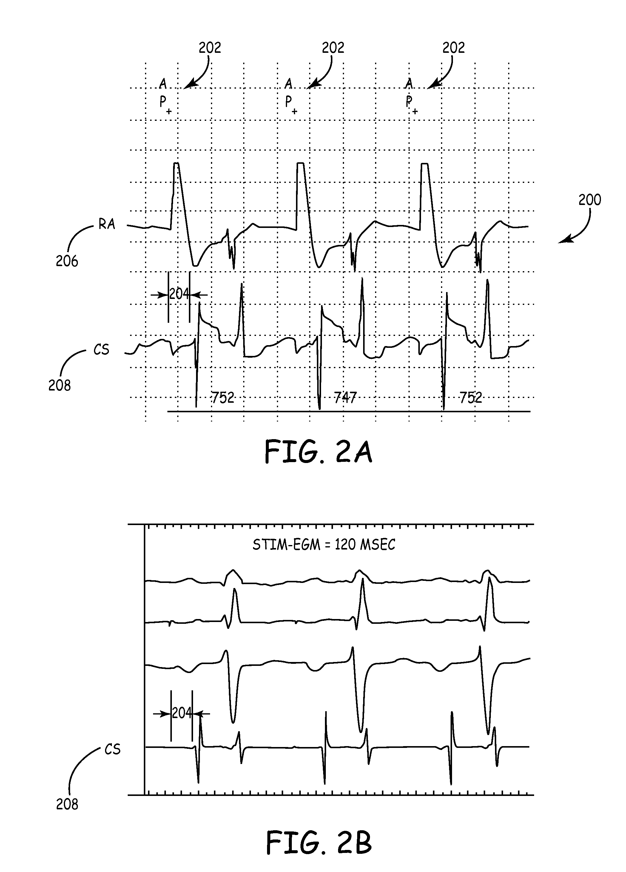 Predicting chronic optimal A-V intervals for biventricular pacing via observed inter-atrial delay