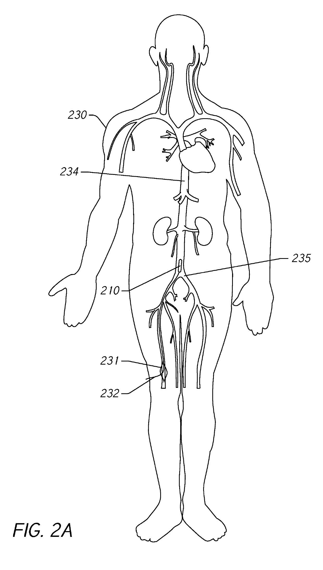 Monitoring blood pressure in the inferior vena cava