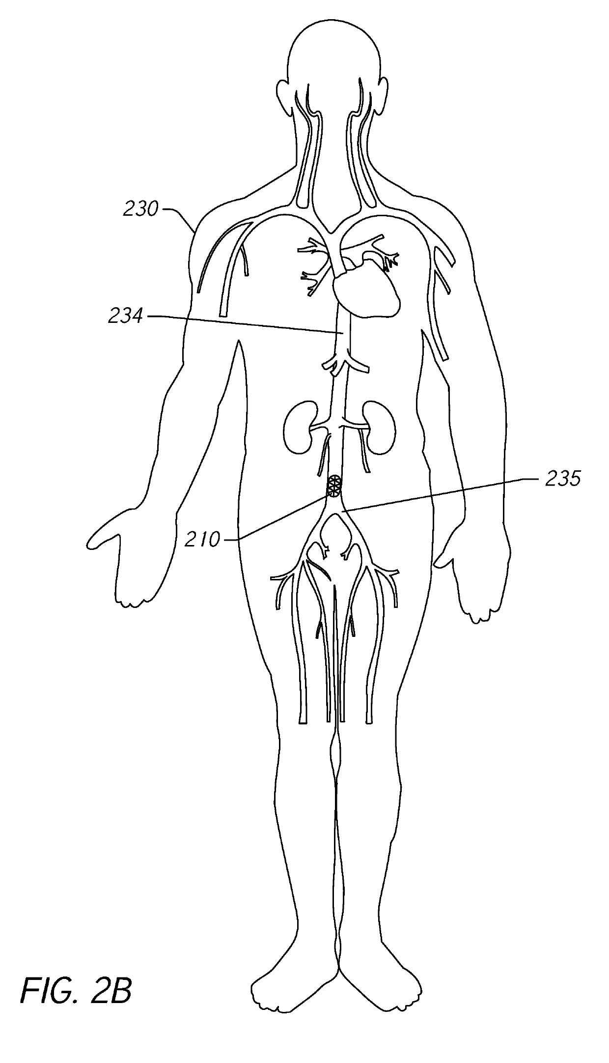 Monitoring blood pressure in the inferior vena cava