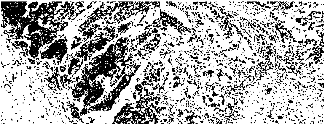 Gastric cancer detection kit and application using hoxb9 and pbx1 as biomarkers