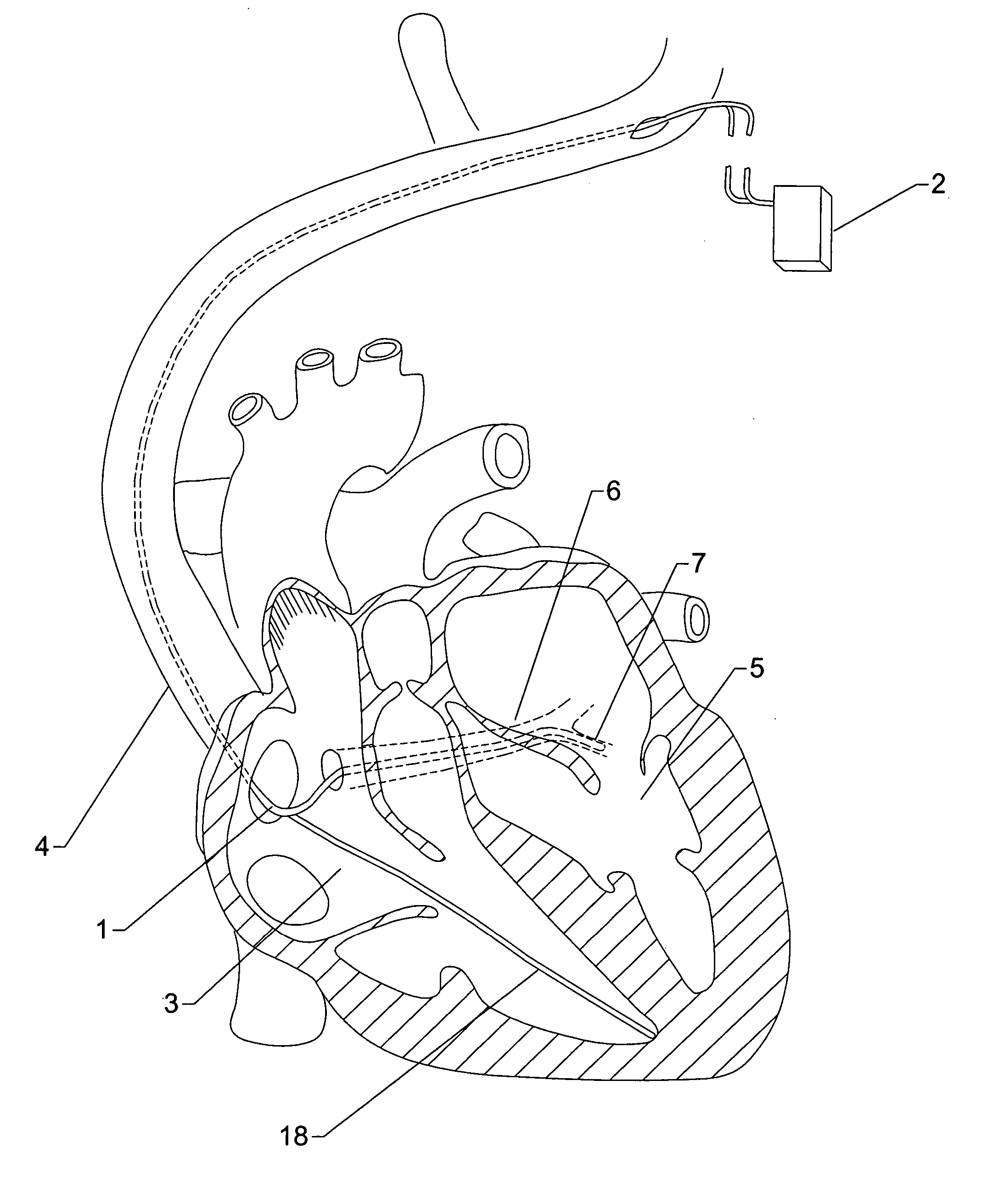 Method and apparatus for adjusting interventricular delay based on ventricular pressure