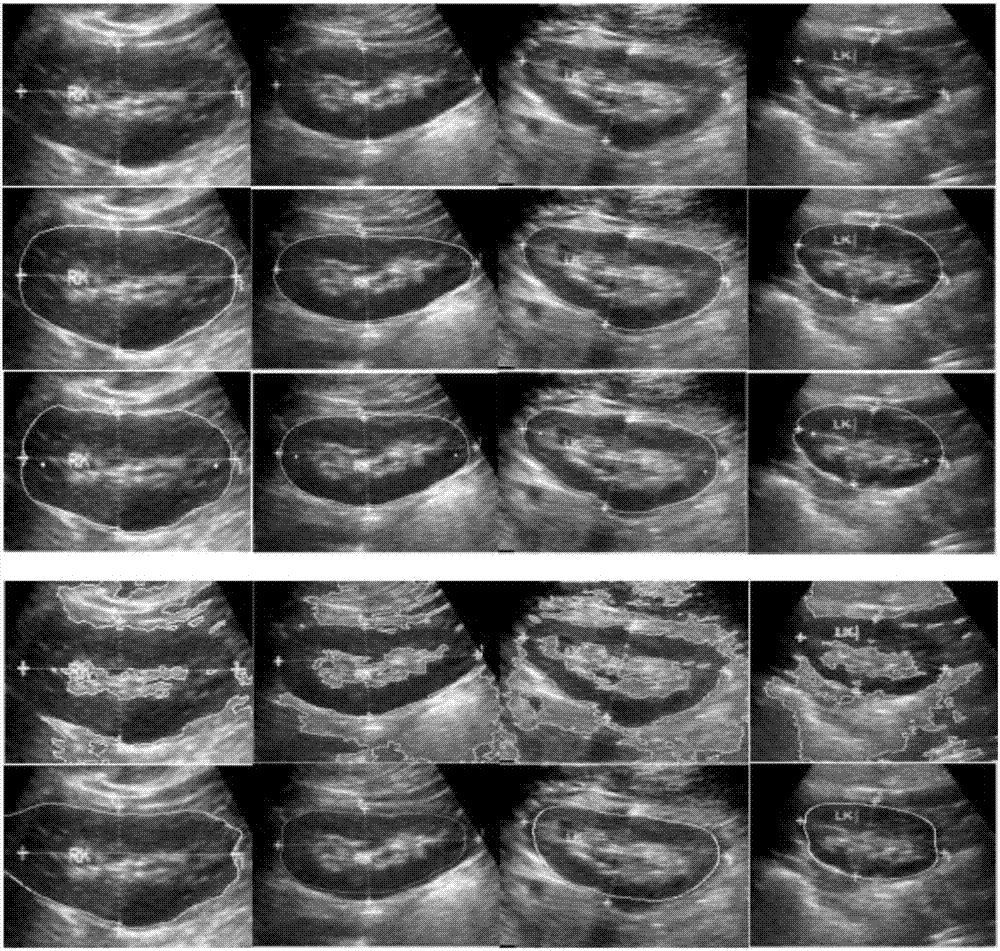 Semi-automatic medical image segmentation method based on shape constraint of point distance function