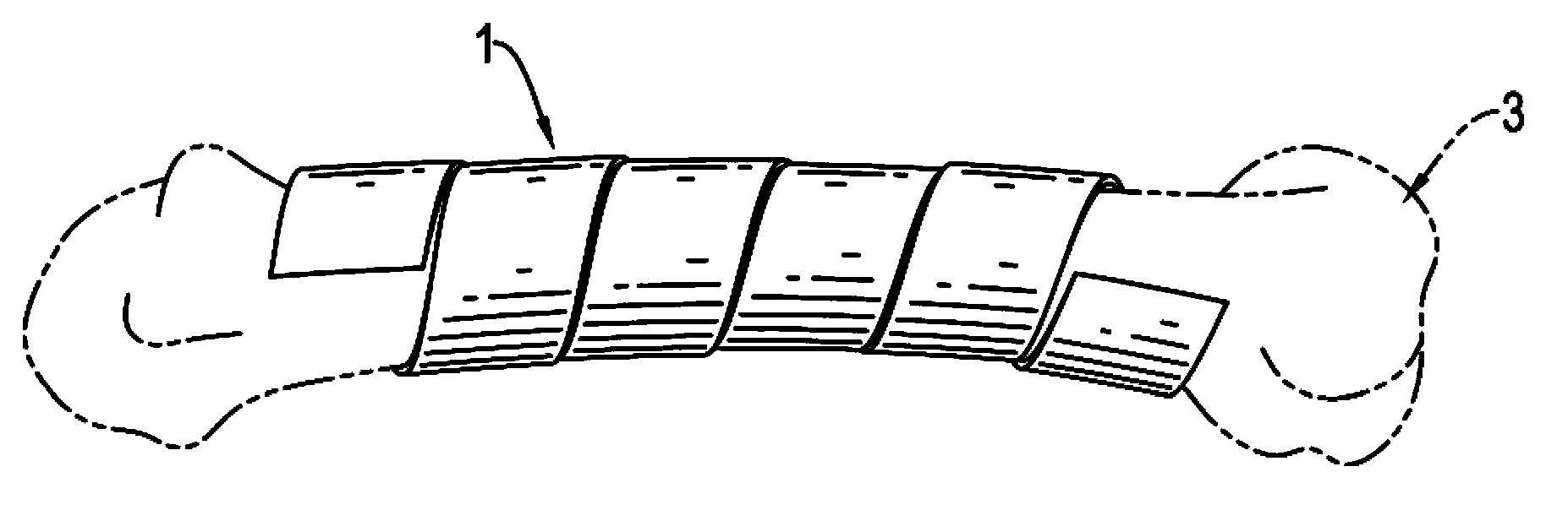 Screw type fracture fixing apparatus