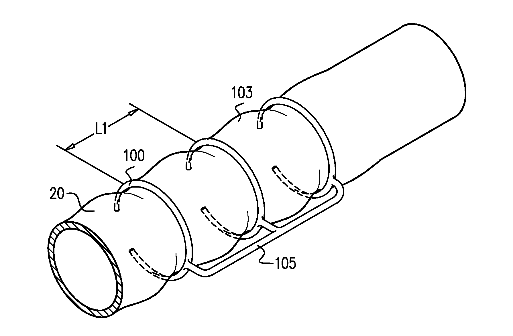 Devices and methods for control of blood pressure