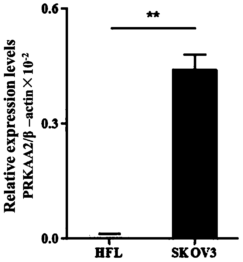 Ovarian cancer diagnosis or prognosis composition and application thereof