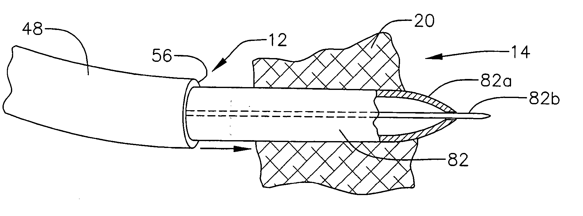 Transseptal needle