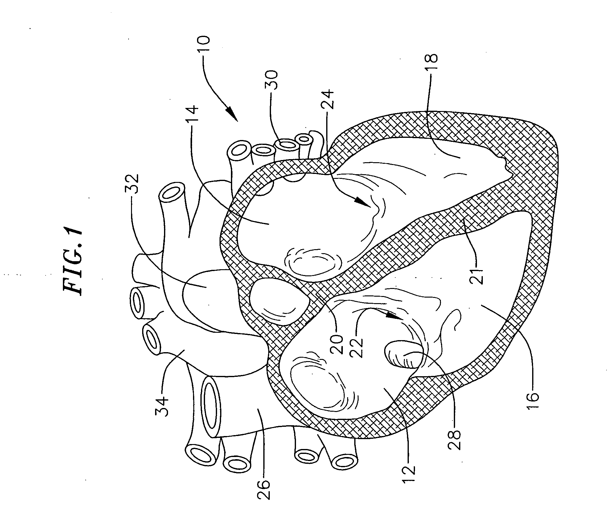 Transseptal needle