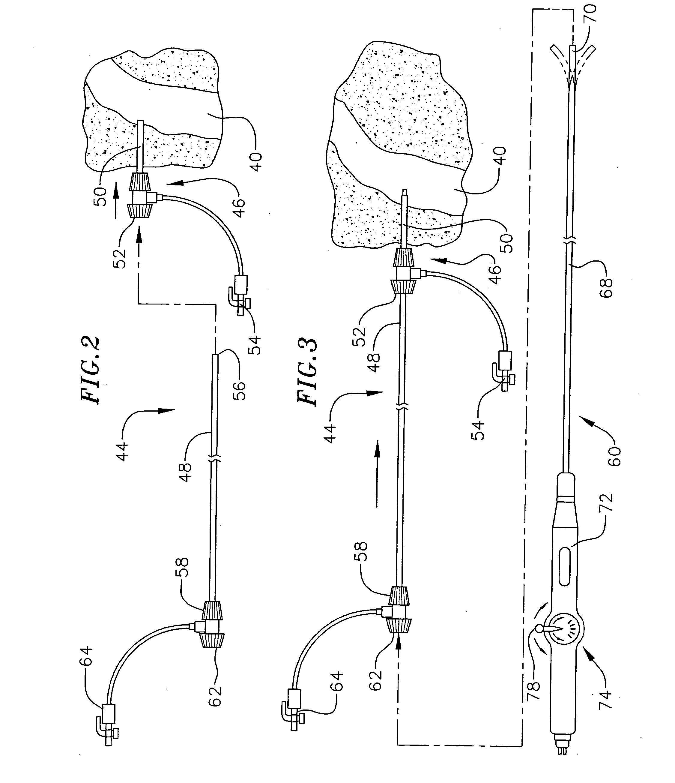 Transseptal needle