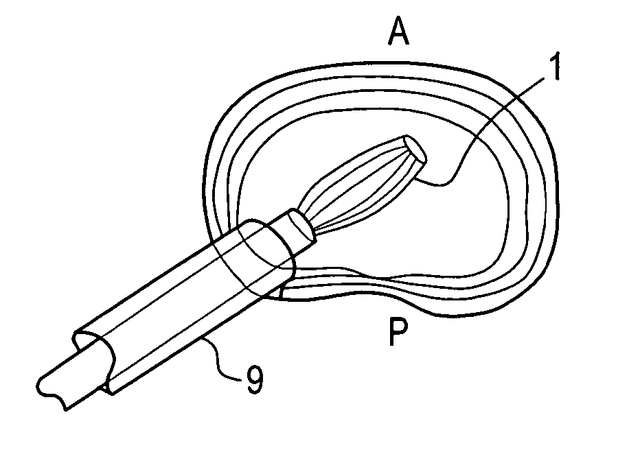 Nucleus pulposus trial device and technique