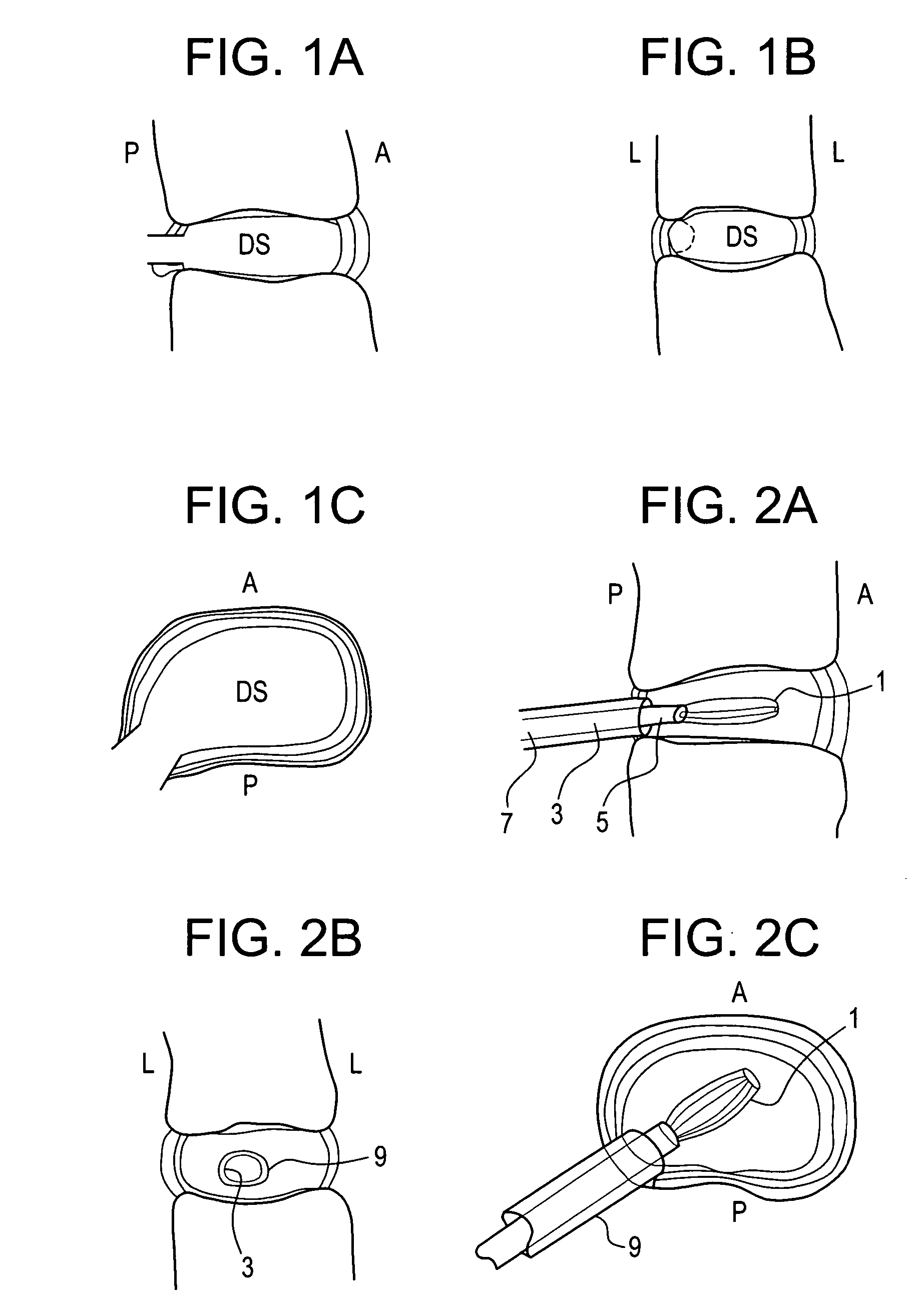 Nucleus pulposus trial device and technique