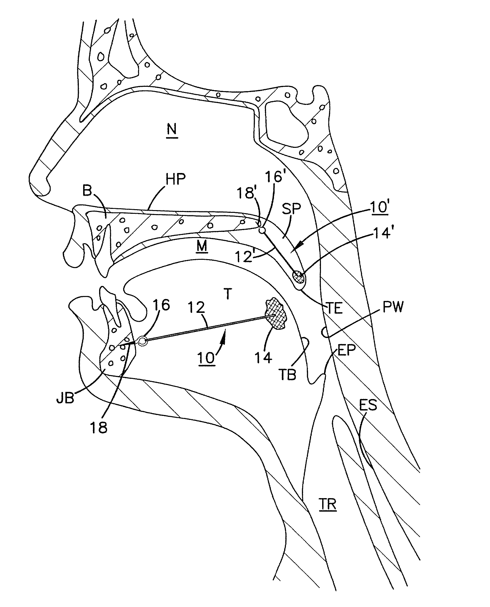 Soft palate implant