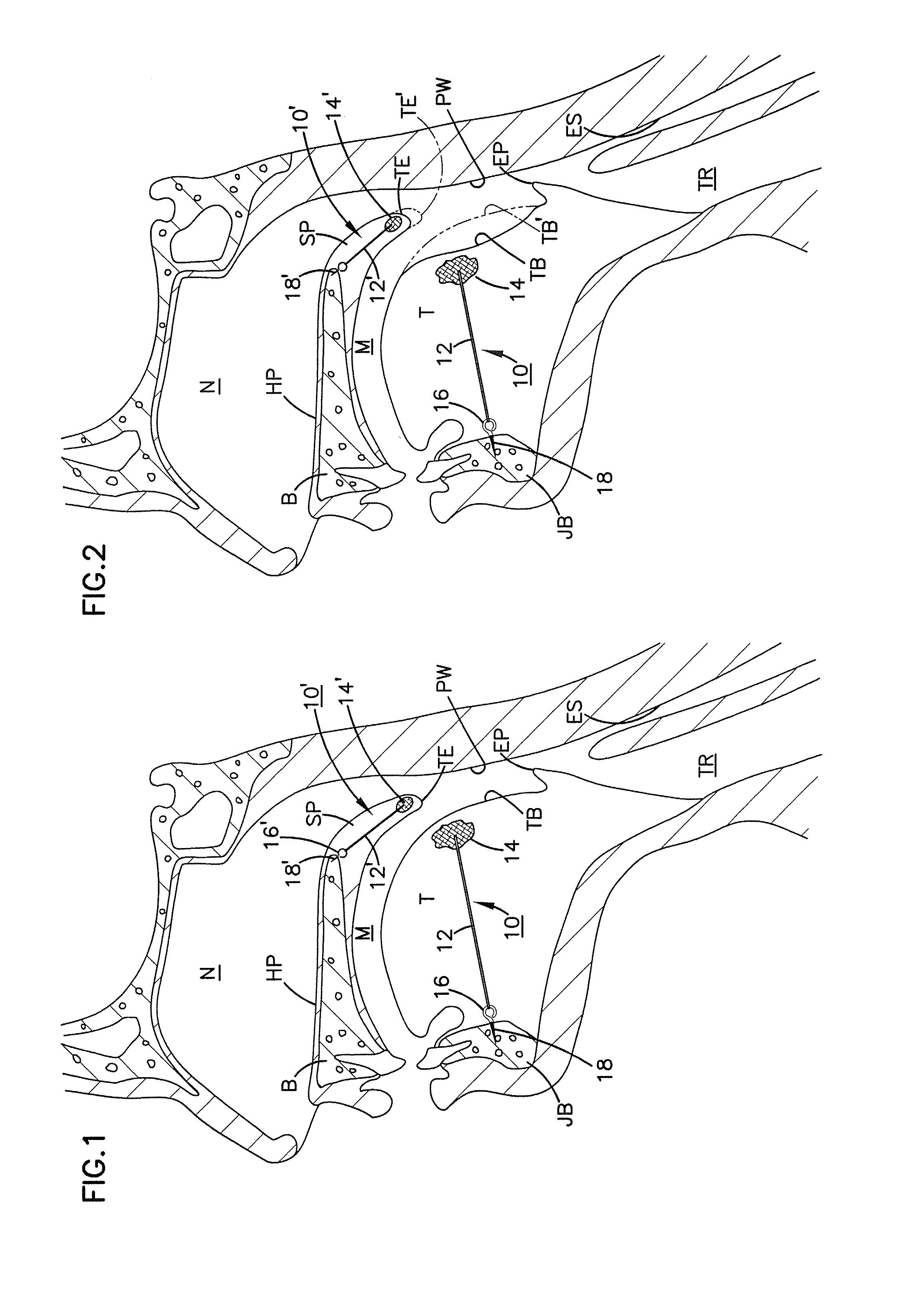 Soft palate implant