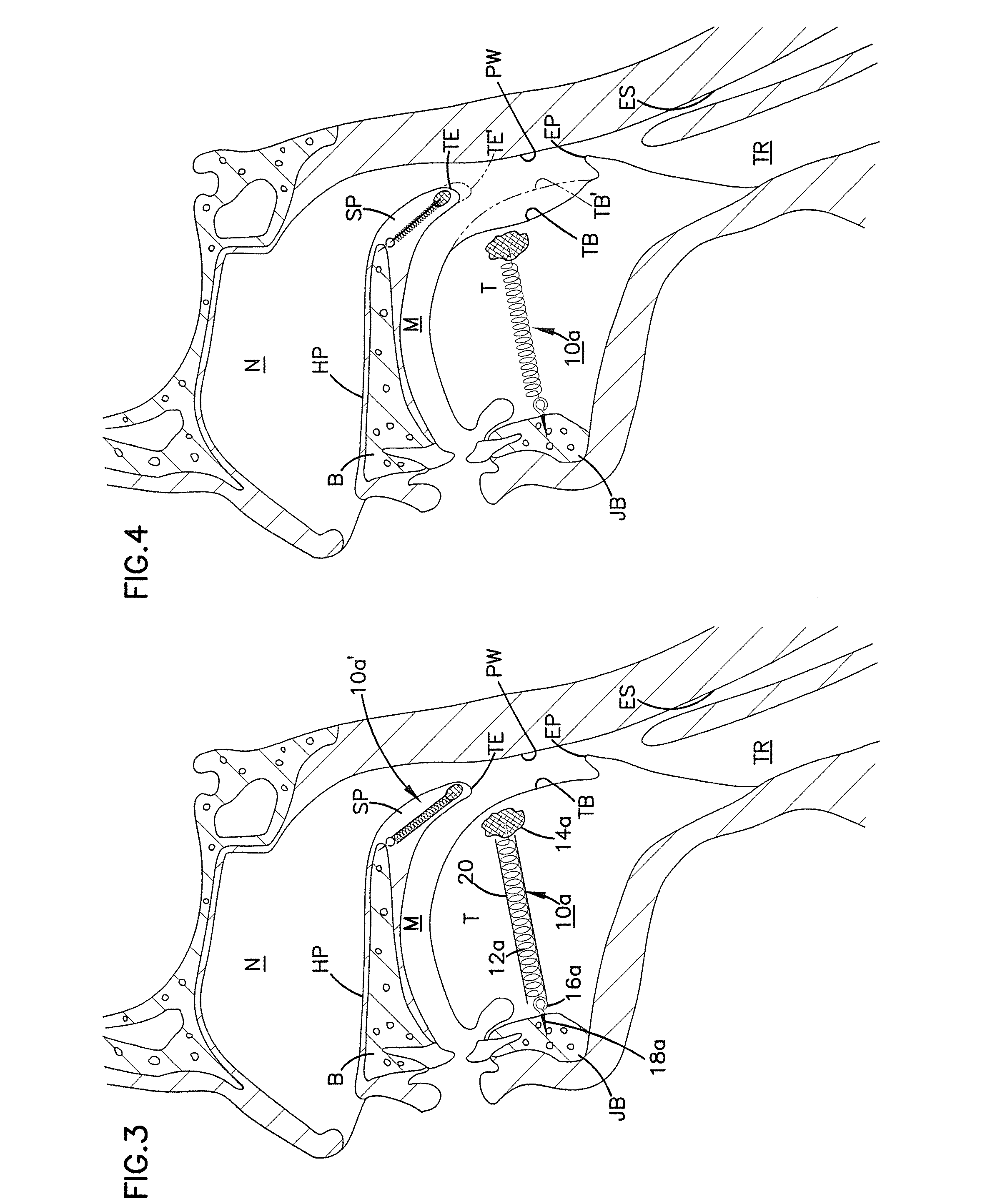 Soft palate implant