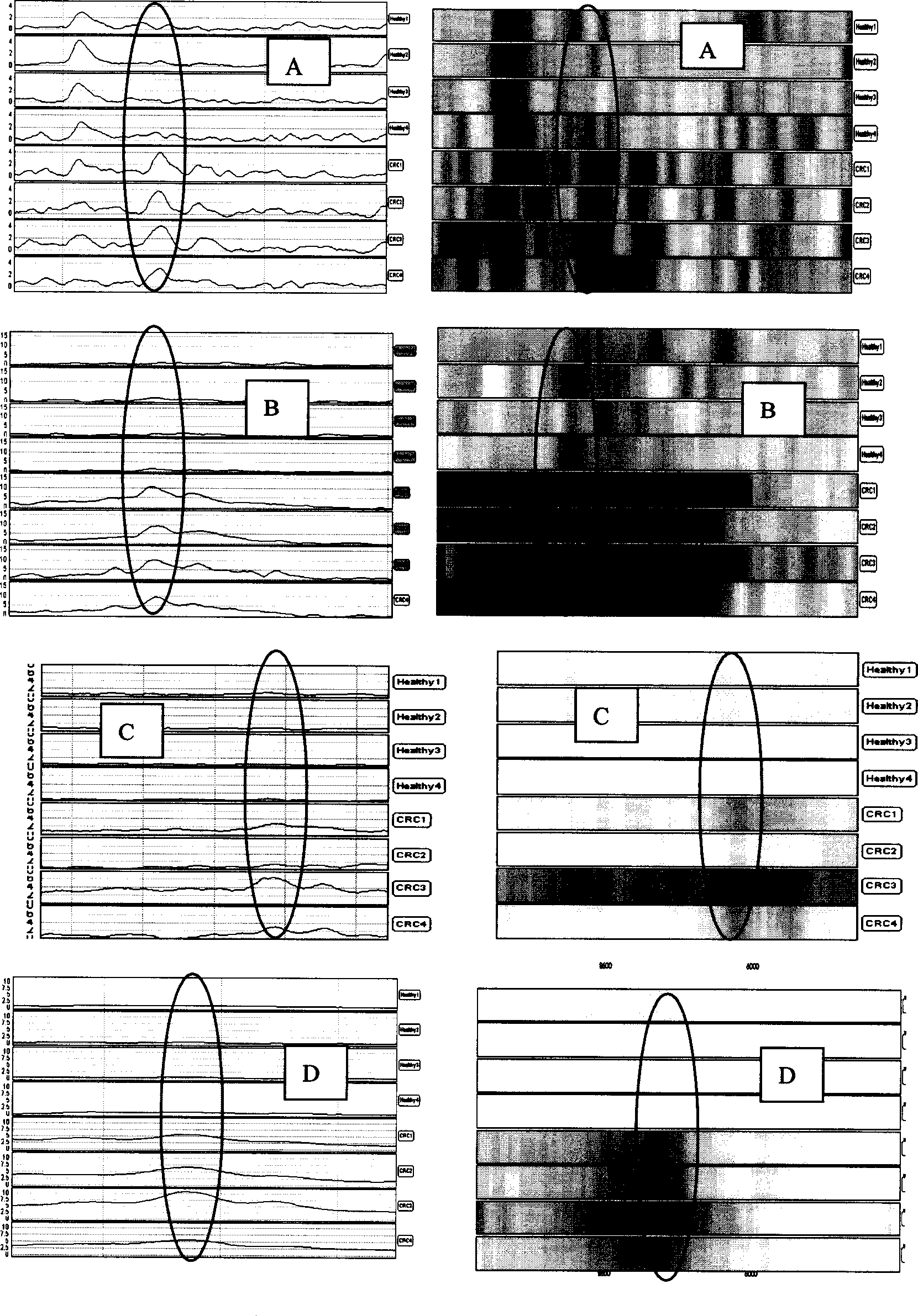 Testing mass spectrum model of blood serum protein in carcinoma of large intestine and its creating method