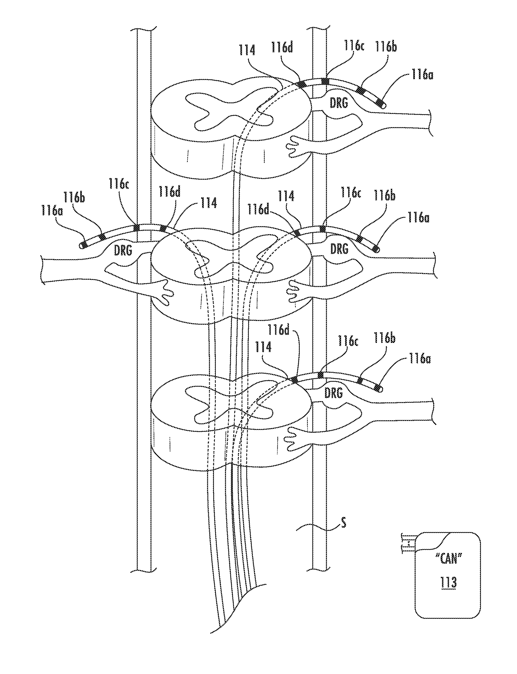 Methods and systems for automatically turning on and off drg stimulation and adjusting drg stimulation parameters