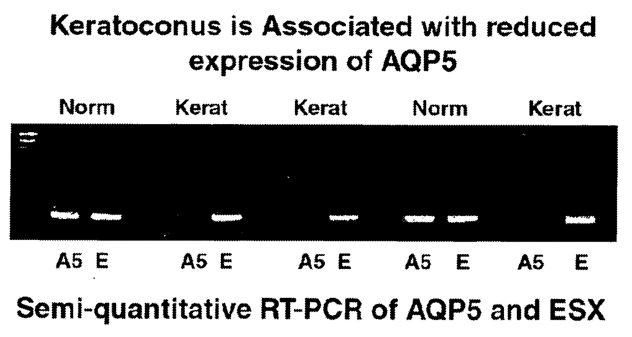 Compositions and methods for detecting keratoconus